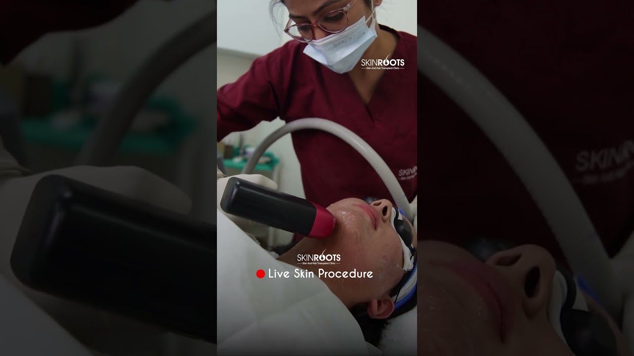 Facial Laser Hair Reductionin Delhi | Safe & Painless Laser Treatment at Skinroots Clinic