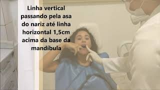 Tomada Radiográfica Periapical Caninos Inferiores