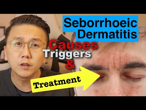 Seborrhoeic Dermatitis - Causes, Triggers & Treatment Options-thumbnail