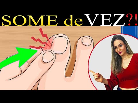 Vídeo: 3 maneiras de se livrar das unhas encravadas