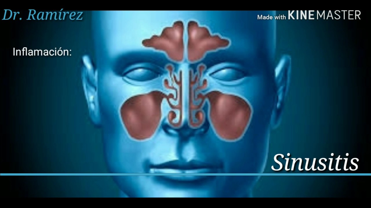Sinusitis aguda y crónica. senos para nasales, dolor de cabeza, mocos, infecciones. - YouTube