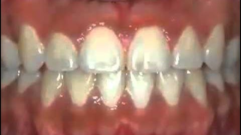 Bracesquestions com   Brushing With Braces, How to Brush Teeth