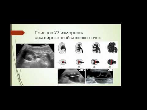 Столова Э.Н. «Возможности ультразвуковой диагностики гидронефроза у детей»