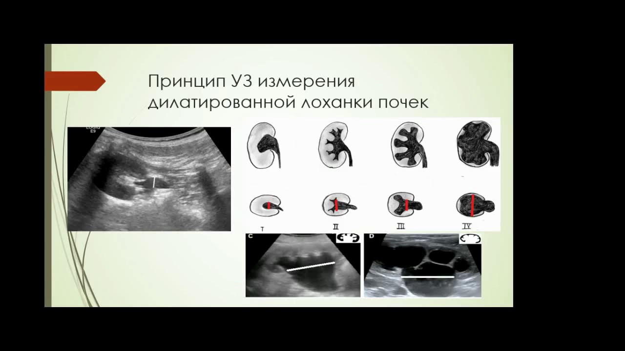 Столова Э.Н. «Возможности ультразвуковой диагностики гидронефроза у ...