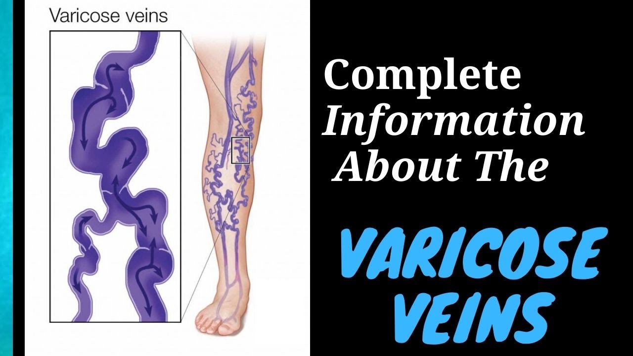 The Best Video For Varicose Veins Youtube