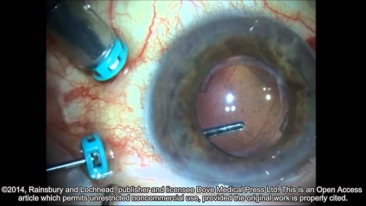 Pars Plana Vitrectomy For Posterior Surface Calcification In A Silicon Opth