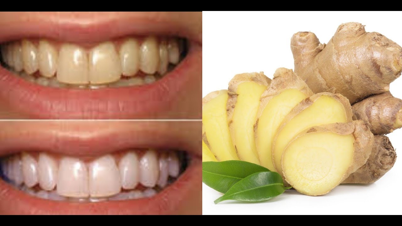 GINGER !!! MAGICAL TEETH WHITENING REMEDY || HOME REMEDY ||दांत सफेद ...