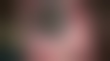 Cataract Surgery - Divide and Conquer Technique