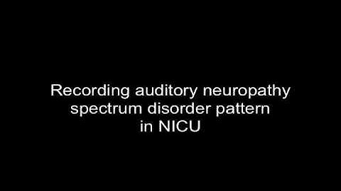 Auditory Neuropathy Spectrum Disorder (ANSD) Recorded in the NICU with Vivosonic Integrity System