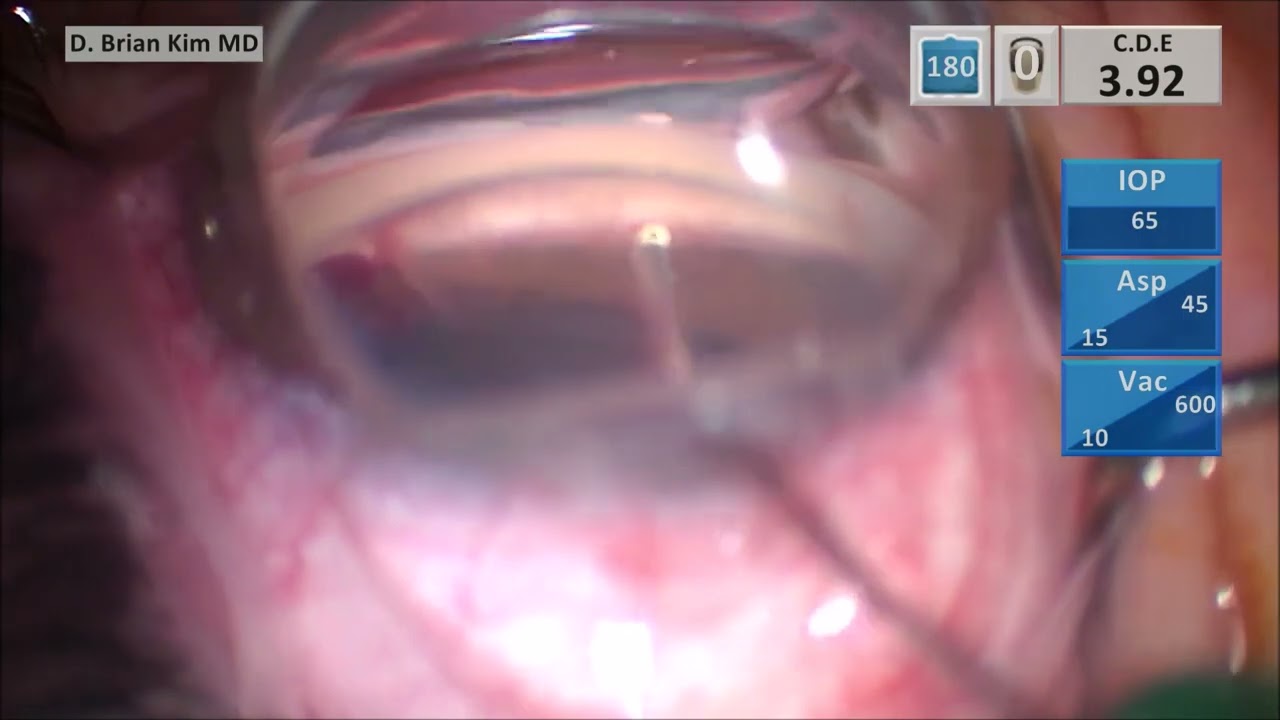 Keys to Success with iStent Inject W - What if 1st Stent Fails