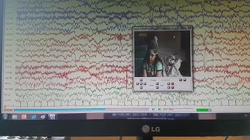 Seizure on video eeg 10