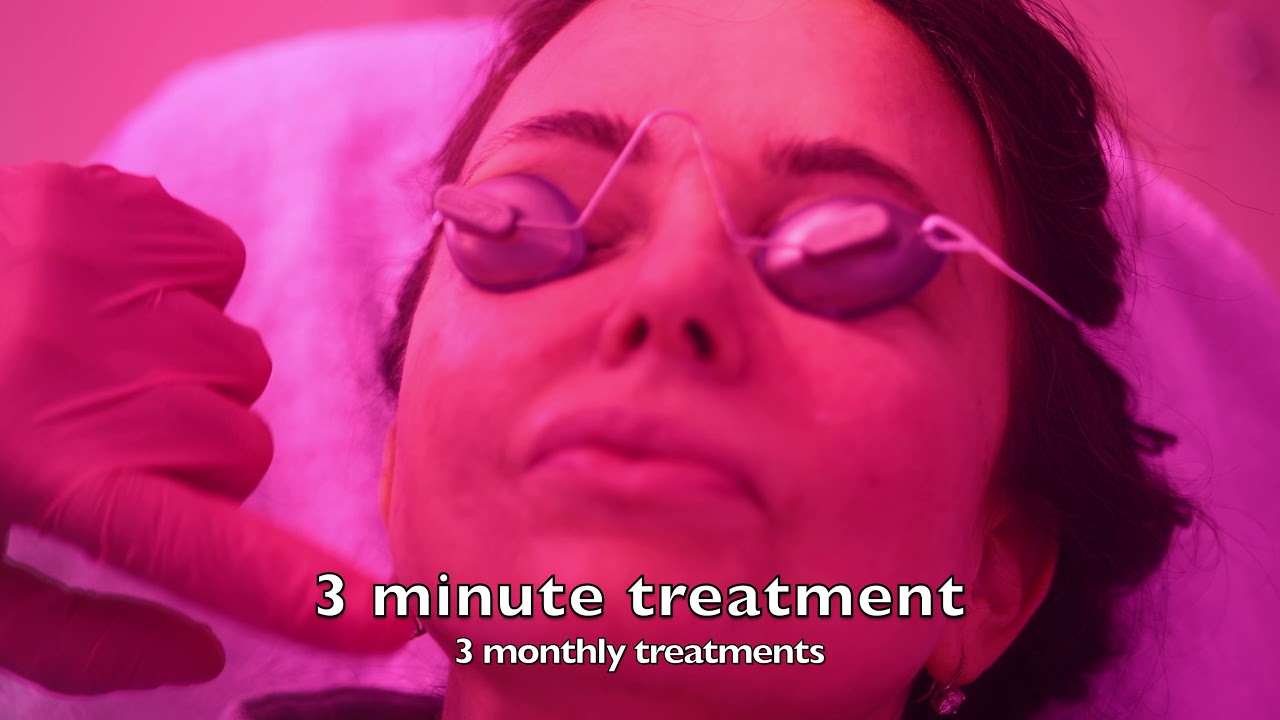 Cutera  Excel V rosacea O