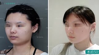 特意从加拿大回来改脸型的求美者，看看她50天的蜕变反馈