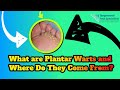 What are Plantar Warts and Where Do They Come From?