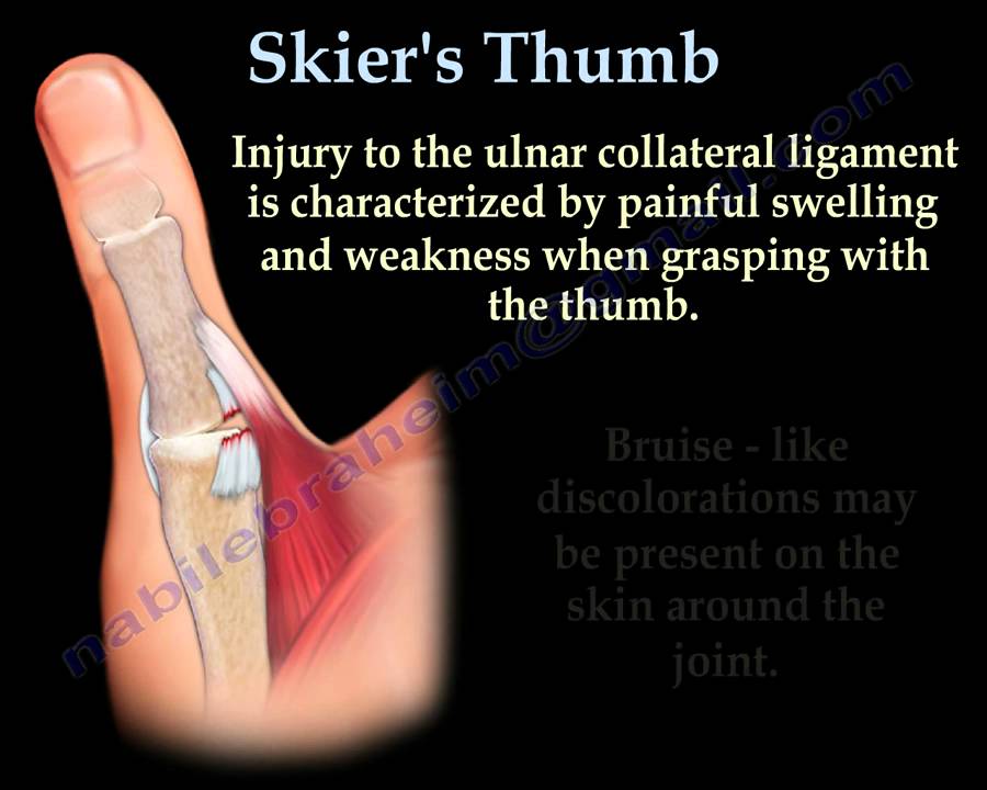 Skier's Thumb Gamekeeper's Thumb - Everything You Need To Know - Dr. Nabil Ebraheim