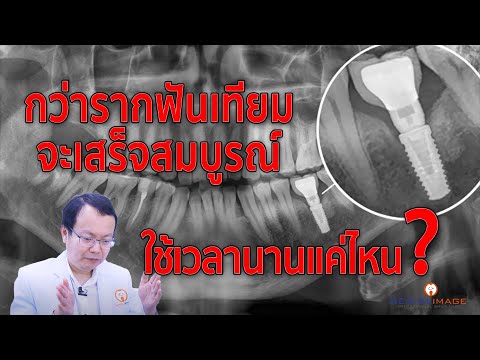 "ฝังรากเทียม" ต้องใช้เวลานานแค่ไหนถึงจะเสร็จสมบรูณ์ | รากฟันเทียม By Dentalimage