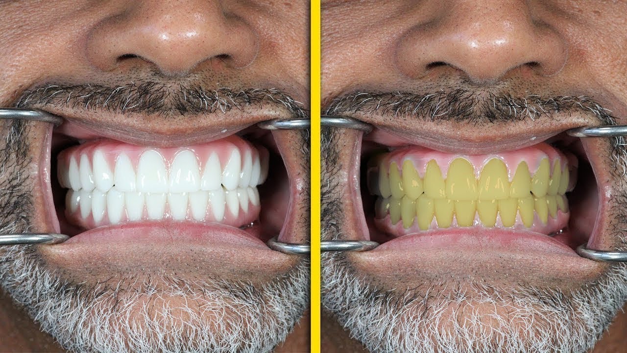 What Will Stain Dental Implants? YouTube