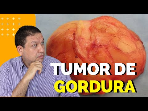 Vídeo: O que causa uma protuberância gordurosa entre os ombros?