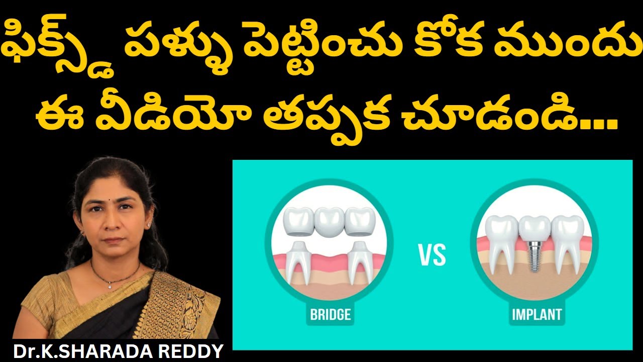 పోయిన పళ్లకు బెస్ట్ ఆప్షన్ | Dental implant vs Teeth Bridge in Telugu | కృత్రిమ దంతాలు ఏది బెటర్