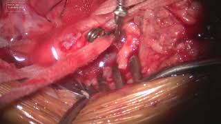 CAROTID ENDARTERECTOMY PART 6