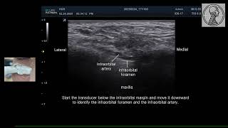 Ultrasound Of The Infraorbital Foramen. Courtesy Of Dr. Mi-Sun Hur