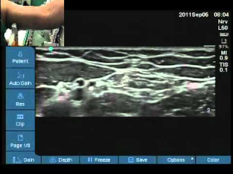 Ultrasound location of medial cutaneous nerve of forearm - YouTube