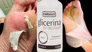 Creme Para Tratar Os Pés Rachados