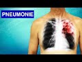 Ref:qFrOCdIWfGI Pneumonie : sympto mes, diagnostic et traitements