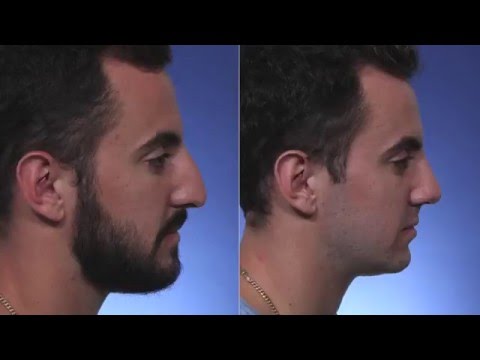 Video thumbnail: Palm Beach Rhinoplasty - Dr. Steiger Reviews · Dr. Jacob D. Steiger MD