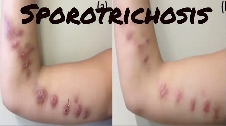 Sporotrichosis "Rose Gardner's Disease"