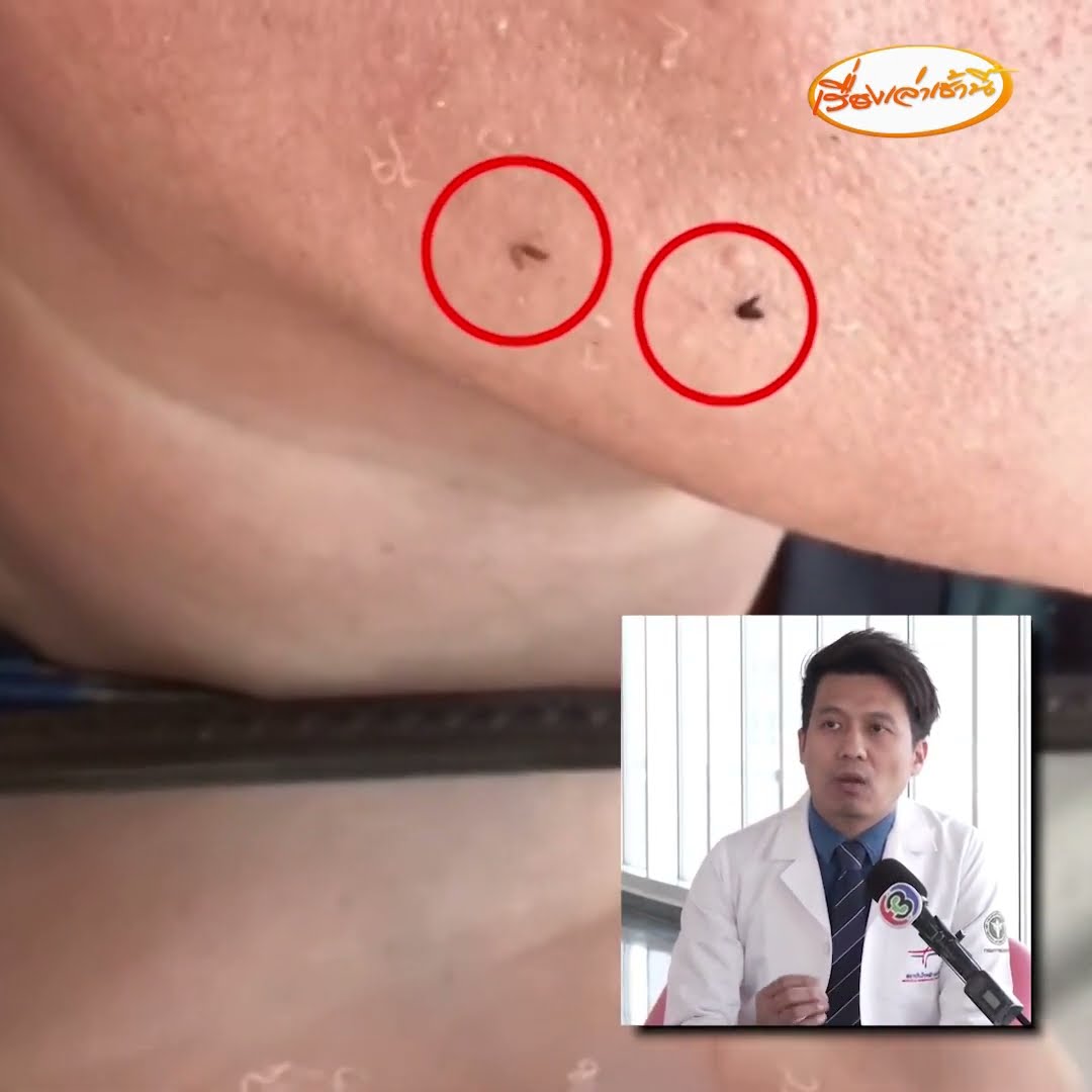 ปวดฟันเจอหนอนผุด หมอผิวหนังบอกเหมือนจับหนอนมาวาง