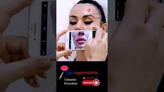 Lip Augmentation 💉  Lip Filler 💋 Cosmetic Procedure 😷 3D