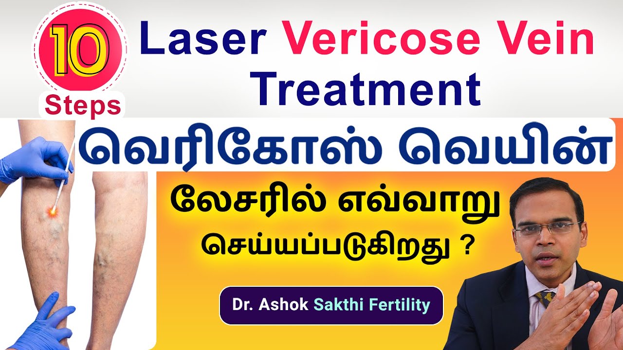 10 Important Steps - Laser Varicose Vein | வெரிகோஸ் வெயின் லேசரில் எவ்வாறு செய்யப்படுகிறது? Dr.Ashok