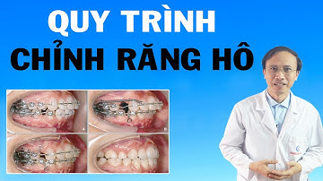 Quy trình chỉnh răng hô I Phạm Thành Công