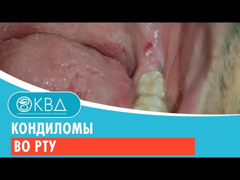 😰 Кондиломы во рту. Клинический случай №760