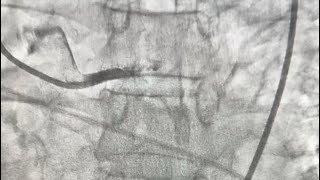Massive Stemi. 100% Occluded Lmladlcx, Ef 10%, Pulmonary Edema, Impella-Assisted Life-Saving Pci
