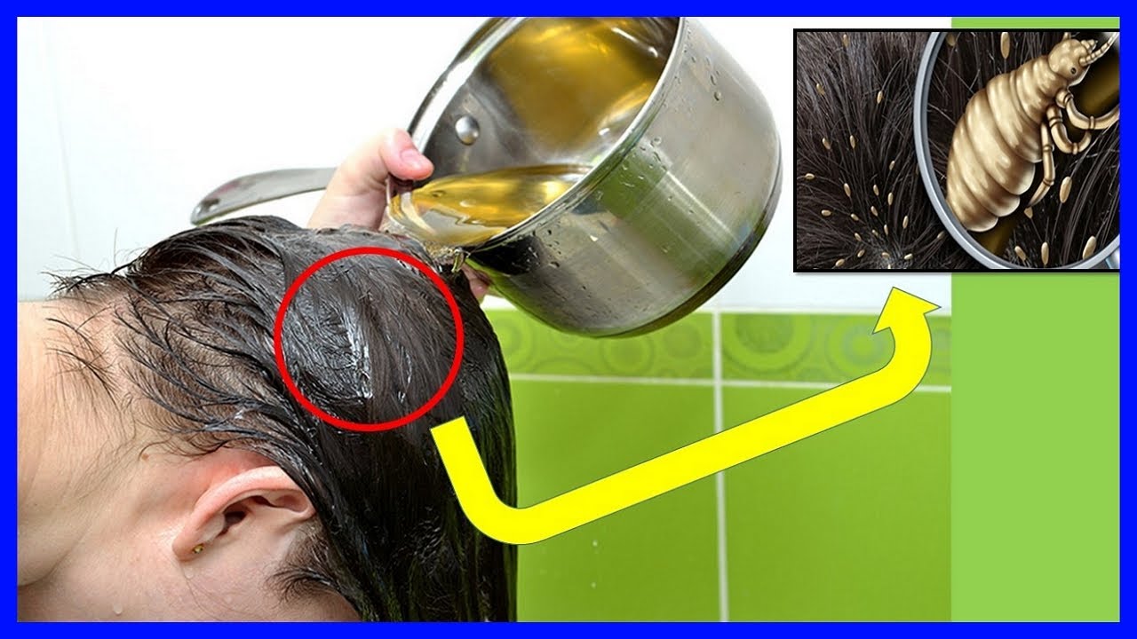 tratamiento para acabar con los piojos medicina para todos piojos