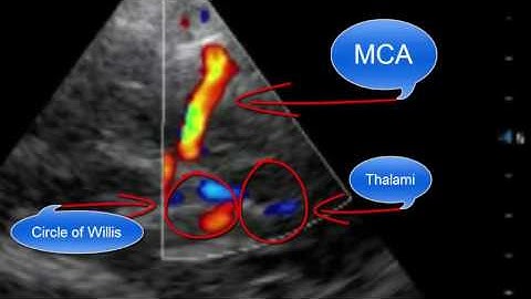 Point-of-care Transcranial Doppler