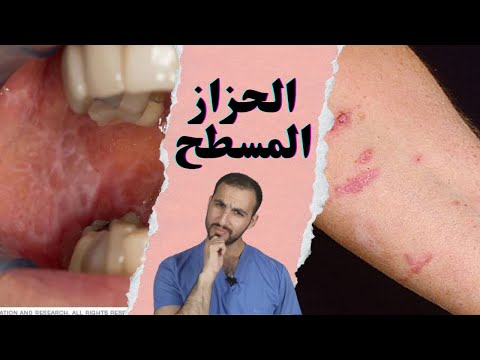 الحزاز المسطح الأعراض و الأسباب و العلاج