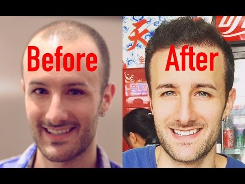 will-you-get-negative-sexual-side-effects-from-finasteride?