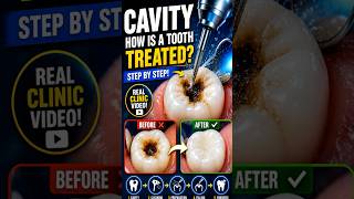 How Dentists Remove Cavities 🦷 | Real Tooth Filling Procedure Step by Step