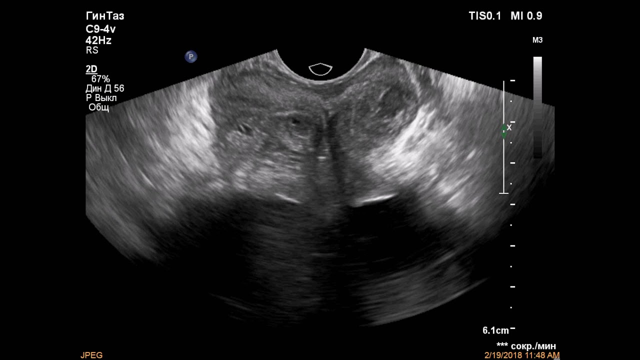 Дгпж узи. Трансректальное УЗИ простаты. УЗИ предстательной железы Изранов. Трузи УЗИ органов мошонки.