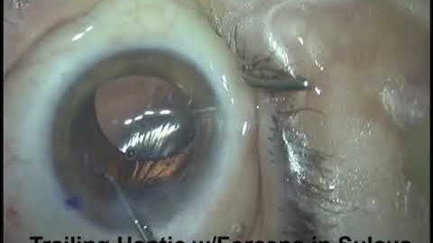 MA 50 in Sulcus with Optic Capture