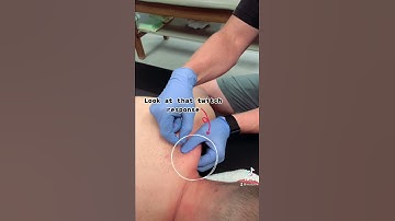 Dry Needling of the Upper Trap