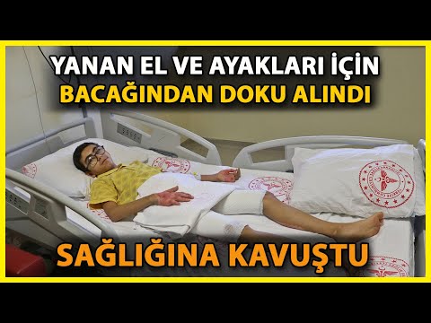 Tinerin Parlamasıyla El ve Ayakları Yanan Ramazan, Doku Nakliyle Sağlığına Kavuştu