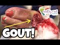 GOUT! WHAT IS GOUT? HOW TO TREAT GOUT, PREVENT GOUT AND AMAZING VIDEOS OF GOUT IN THE FOOT!