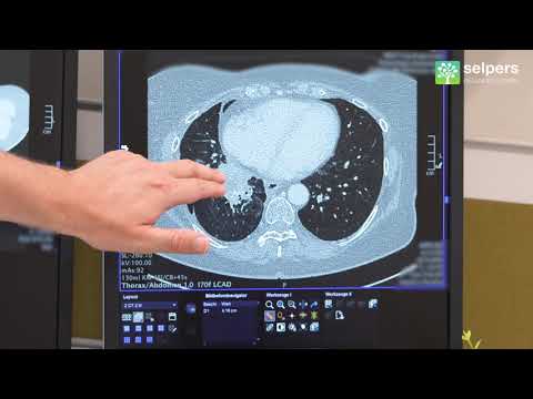 Video: Multi-Window-CT-basierte Radiomische Signaturen Zur Unterscheidung Von Indolentem Und Aggressivem Lungenkrebs In Der National Lung Screening Trial: Eine Retrospektive Studie