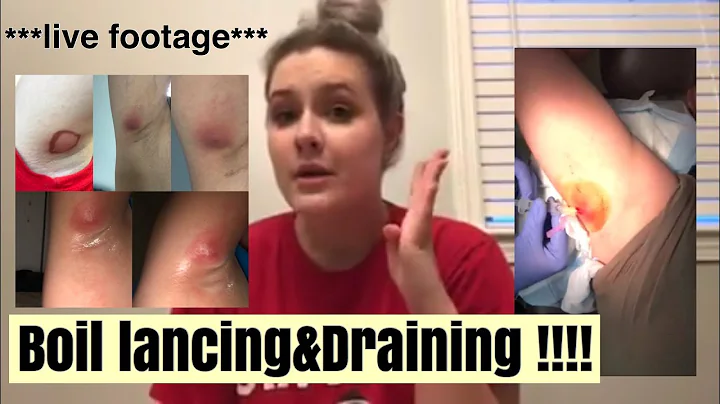 BOIL LANCING & DRAINING ***LIVE FOOTAGE*** | KELLE...