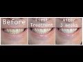 Brushing Teeth With Baking Soda And Hydrogen Peroxide Safe Brushing Teeth With Baking Soda And Hydrogen Peroxide Safe