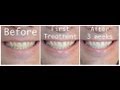 How-to Whiten your teeth with Hydrogen Peroxide